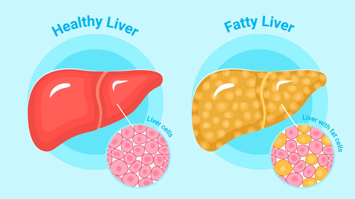 main_fattyliver