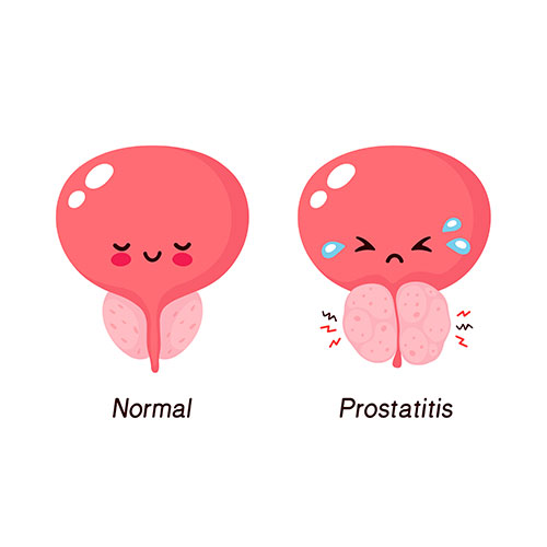 bph-enlarged-prostate-treatment-chennai